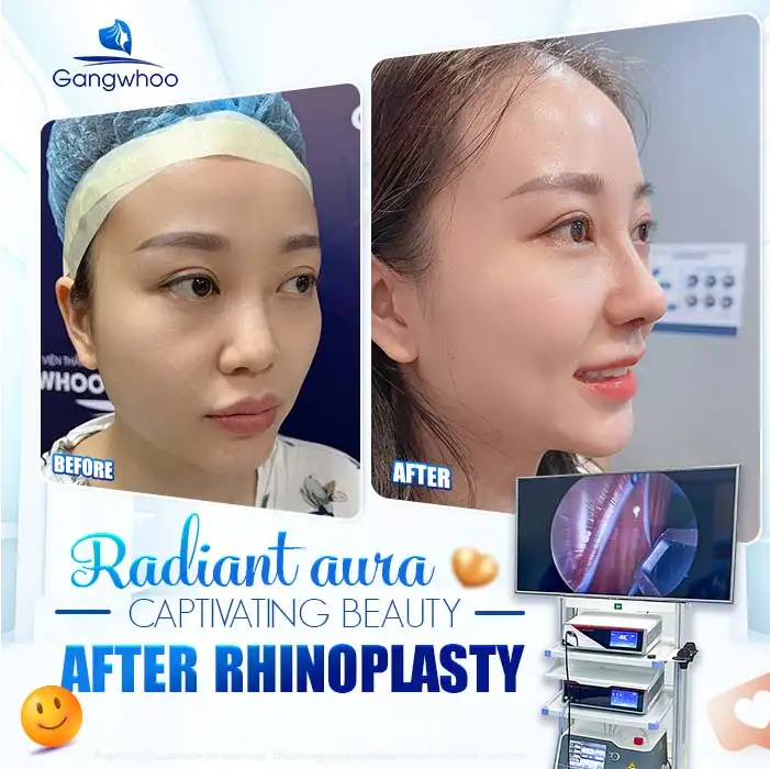 What is temporalis fascia–wrapped rhinoplasty? What effects does this technique have on the face?