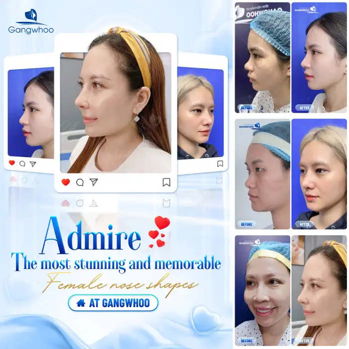 Is it advisable to raise the nose too high? Is an overly high rhinoplasty safe?