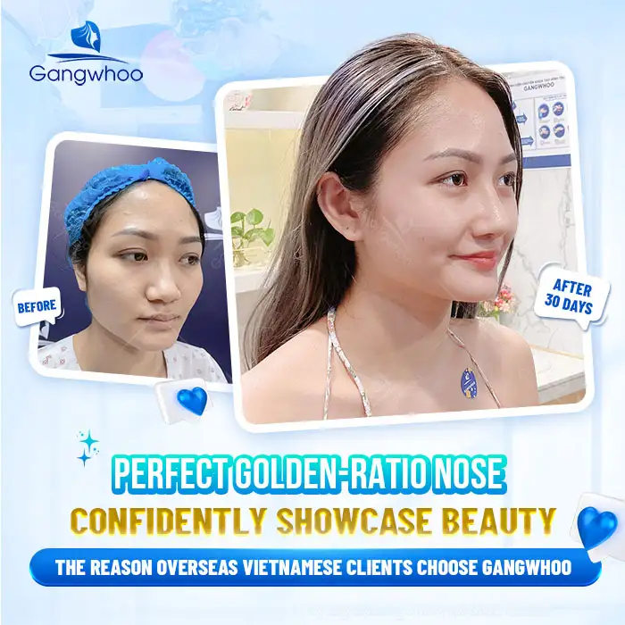 Is 4D Structural Rhinoplasty Permanent? Postoperative Care to Maintain Long-Lasting Results