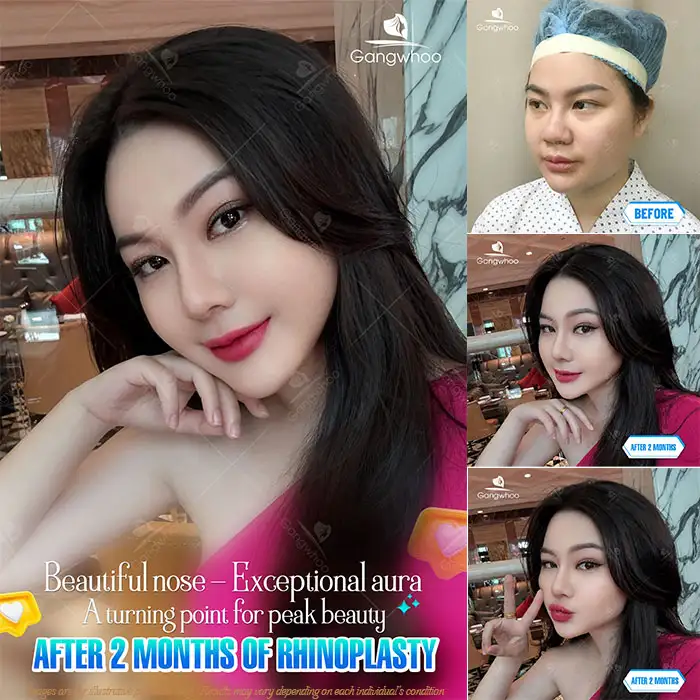 Is 4D Structural Rhinoplasty Permanent? Postoperative Care to Maintain Long-Lasting Results