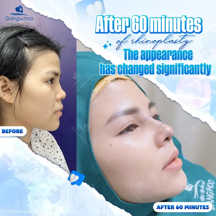 What Is 4D Structural Autologous Rhinoplasty? How Is It Different From Other Rhinoplasty Methods?