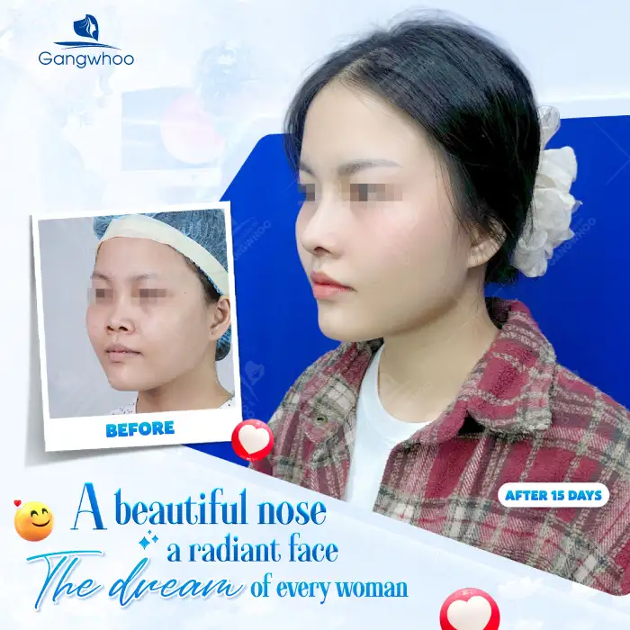 What Is 4D Structural Autologous Rhinoplasty? How Is It Different From Other Rhinoplasty Methods?