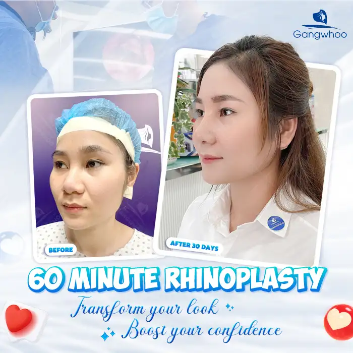 What Is 4D Structural Autologous Rhinoplasty? How Is It Different From Other Rhinoplasty Methods?