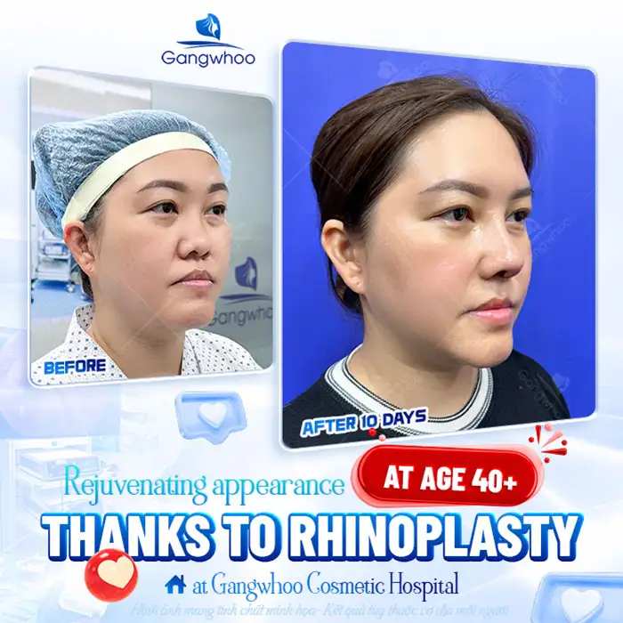 What Is Biologic Thread Nose Augmentation and How Effective Is It?