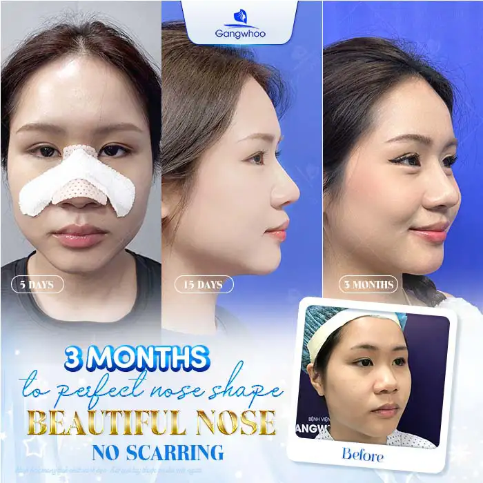 Will rhinoplasty leave scars, and how should it be cared for to ensure good healing?