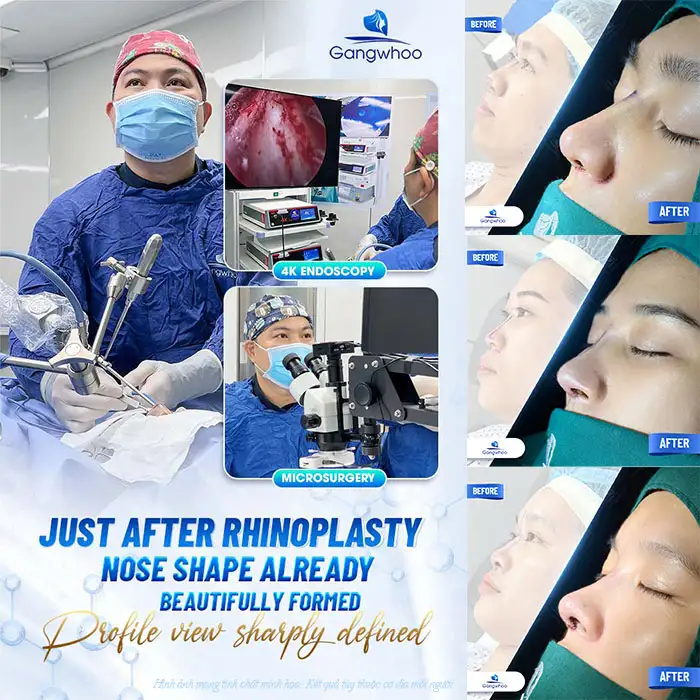 Will rhinoplasty leave scars, and how should it be cared for to ensure good healing?