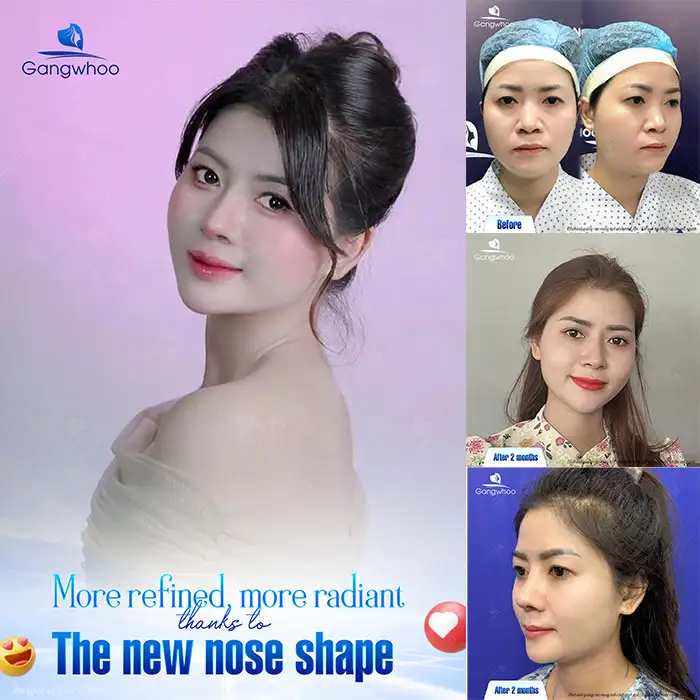 Does rhinoplasty change the face? To what extent can it change while still maintaining a natural look?