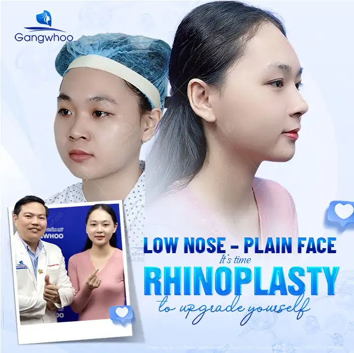 Does rhinoplasty change the face? To what extent can it change while still maintaining a natural look?