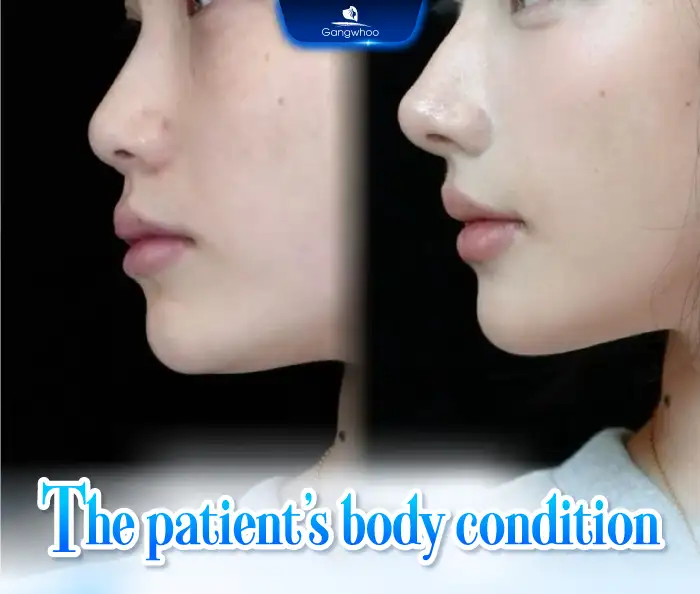 How long does filler nose augmentation last? When does it dissolve?