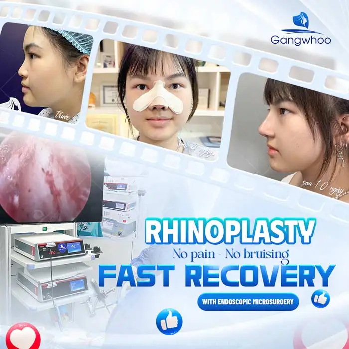 What is Gore-Tex rhinoplasty? Advantages and disadvantages of Gore-Tex material
