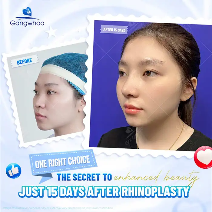 What is Gore-Tex rhinoplasty? Advantages and disadvantages of Gore-Tex material