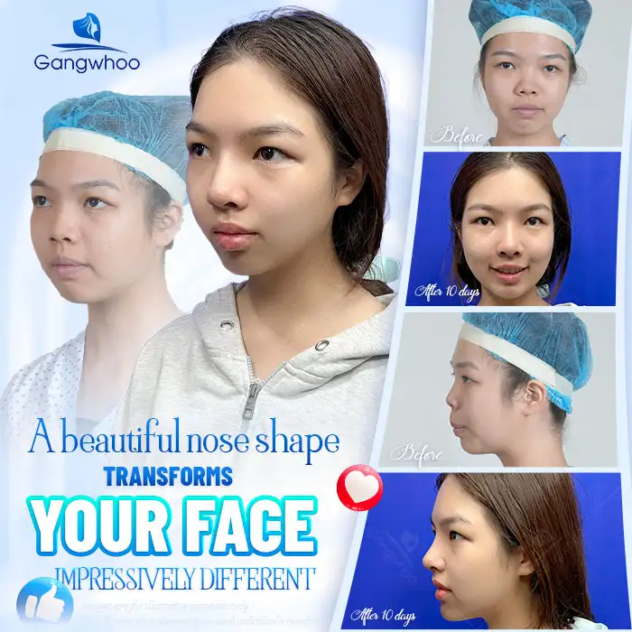 What Is Nasal Tip Elevation? Which Cases Is This Method Suitable For?