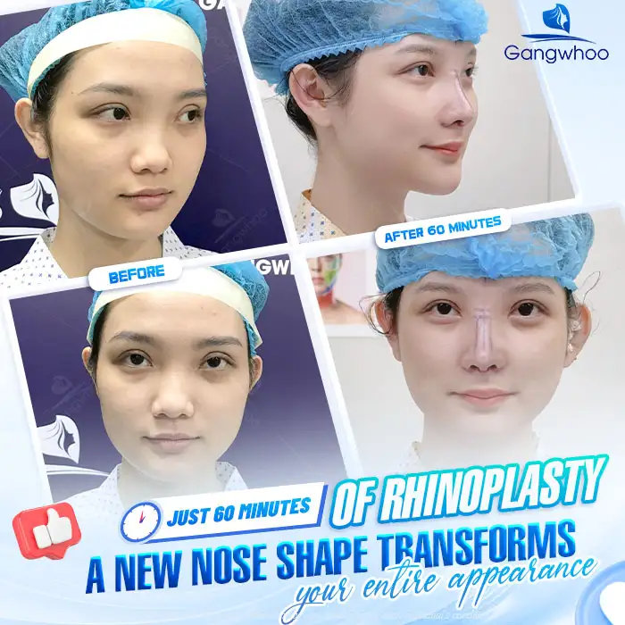 What Is Nasal Tip Elevation? Which Cases Is This Method Suitable For?