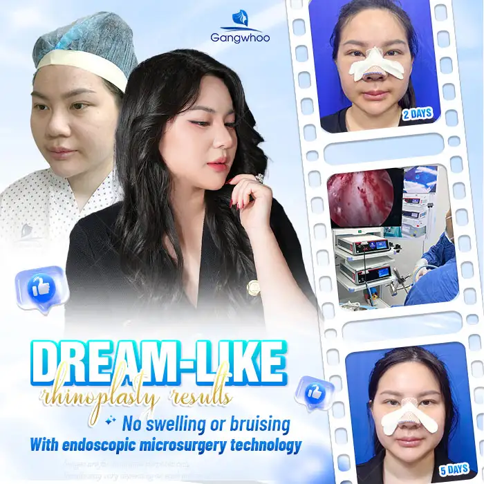 What Is Nasal Tip Elevation? Which Cases Is This Method Suitable For?