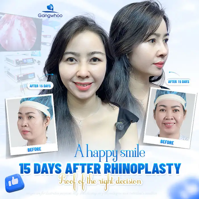 What Is Nasal Tip Elevation? Which Cases Is This Method Suitable For?