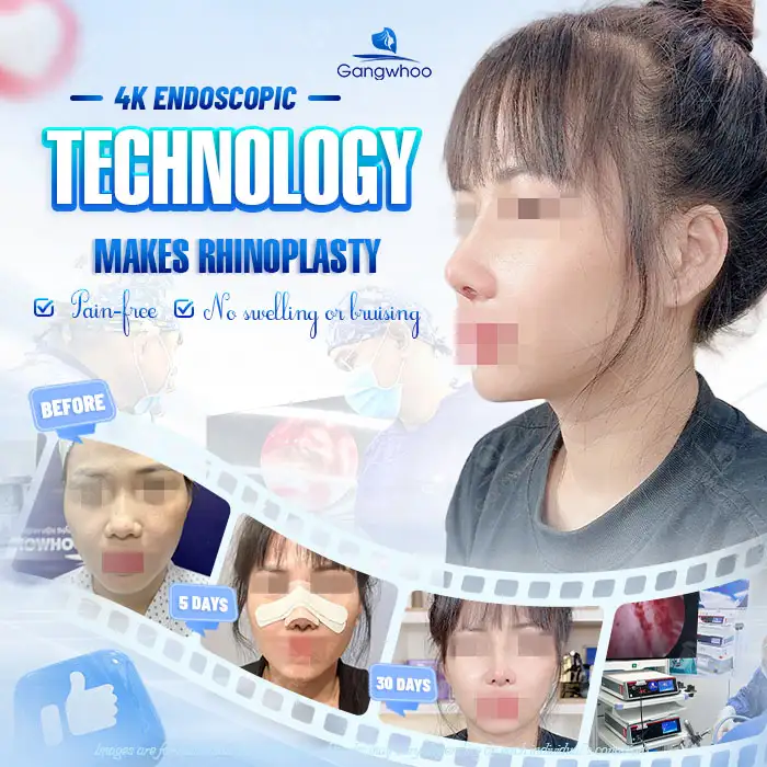 Does rhinoplasty without tip grafting have any impact? What should be noted?