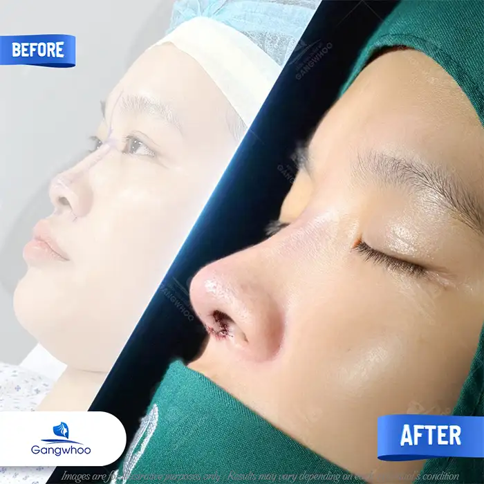 What is Thai-style rhinoplasty? How is it different from other methods?