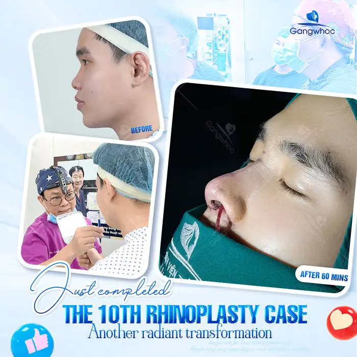 What Is L Line 3D Rhinoplasty? How Is It Different from S Line Rhinoplasty?