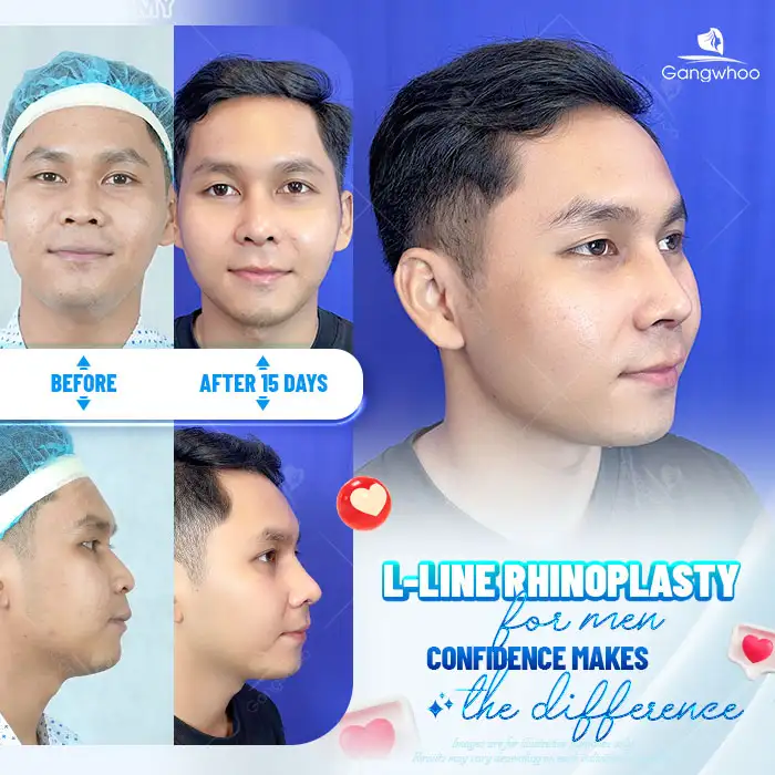 What Is L Line 3D Rhinoplasty? How Is It Different from S Line Rhinoplasty?