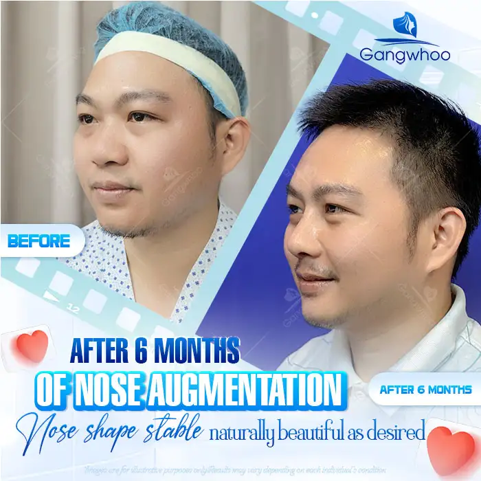 What is L Line 4D rhinoplasty? What outstanding advantages does it have?