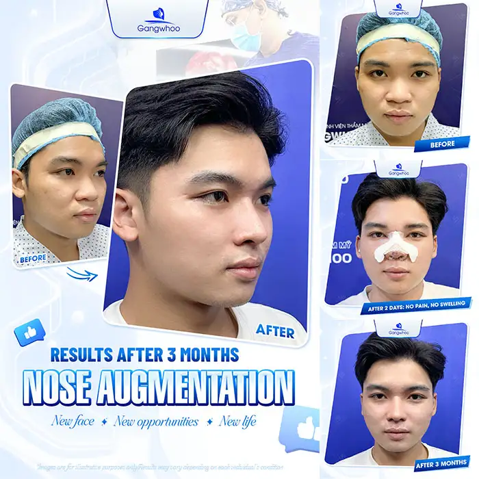 What is L Line 4D rhinoplasty? What outstanding advantages does it have?