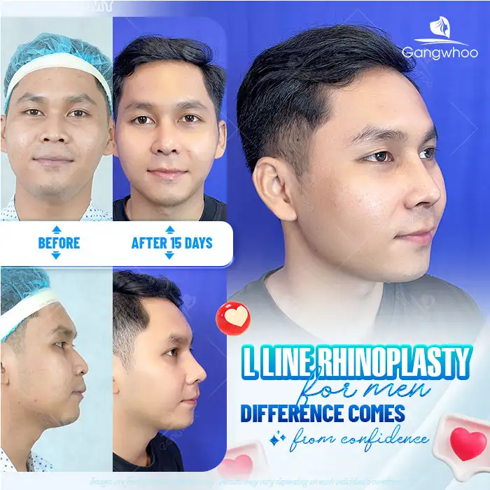 How much does L Line rhinoplasty cost? Updated latest price list 2025 1 How much does L Line rhinoplasty cost? Updated latest price list 2025