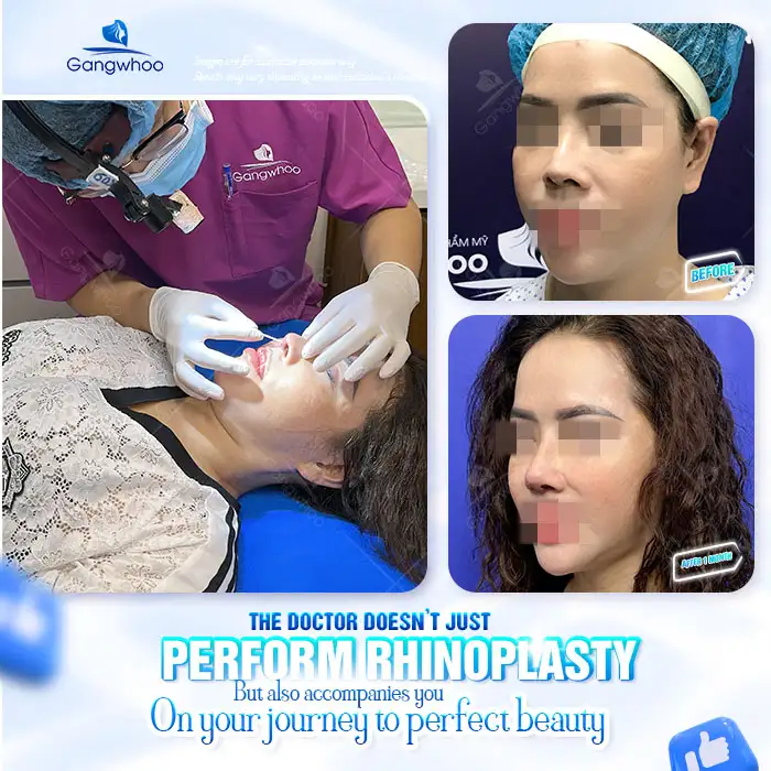 Is secondary rhinoplasty painful? Sharing experience with secondary rhinoplasty