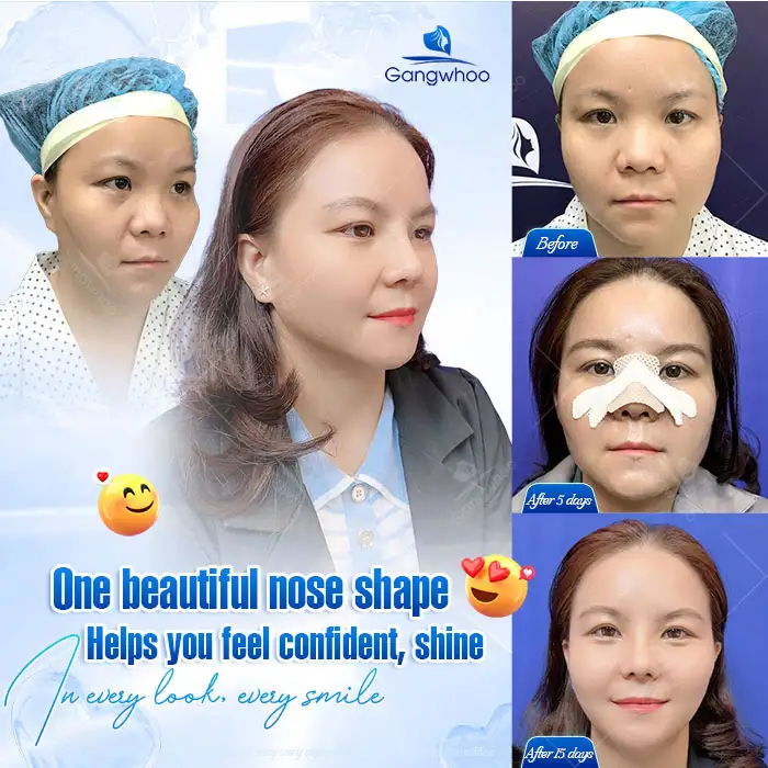 What Is Demi 5D Rhinoplasty? How Is It Different From Other Methods?