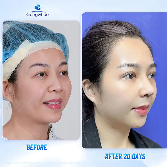 What Is Demi 5D Rhinoplasty? How Is It Different From Other Methods?