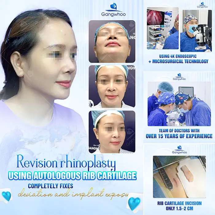Is it harmful to revise or undergo multiple rhinoplasty procedures? When is revision rhinoplasty necessary?