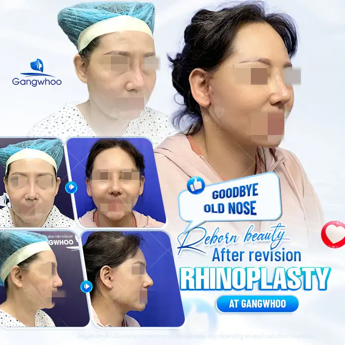 Is it harmful to revise or undergo multiple rhinoplasty procedures? When is revision rhinoplasty necessary?