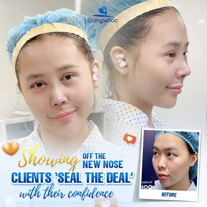 What Is the 4K Endoscopic Rhinoplasty Method? How Is It Different from Traditional Rhinoplasty?