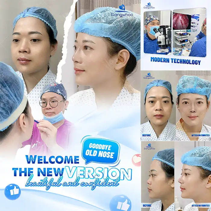 What Is the 4K Endoscopic Rhinoplasty Method? How Is It Different from Traditional Rhinoplasty?