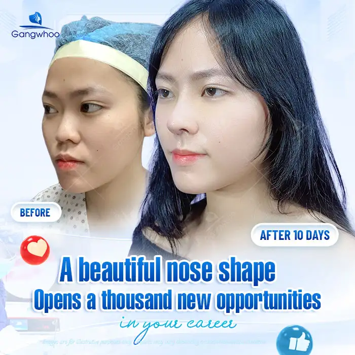 What Is the 4K Endoscopic Rhinoplasty Method? How Is It Different from Traditional Rhinoplasty?