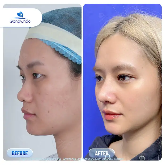 What Is the 4K Endoscopic Rhinoplasty Method? How Is It Different from Traditional Rhinoplasty?