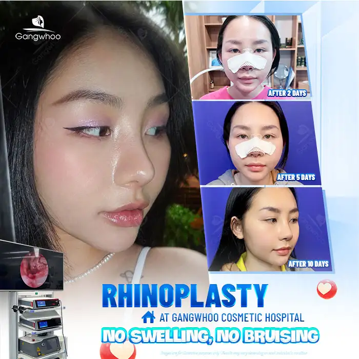 How to choose a rhinoplasty style that suits your face?