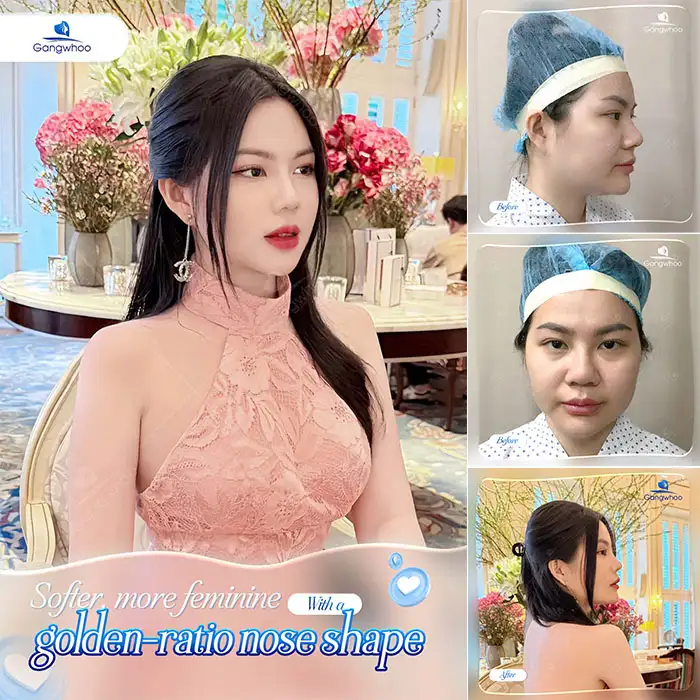 What is double-layer S-line rhinoplasty? Should this method be chosen?