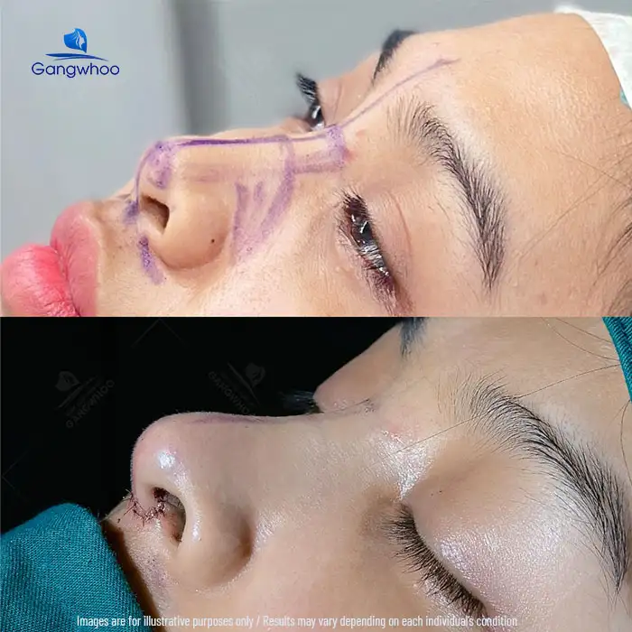 How long does it take for an S Line rhinoplasty to look beautiful? Factors affecting recovery time