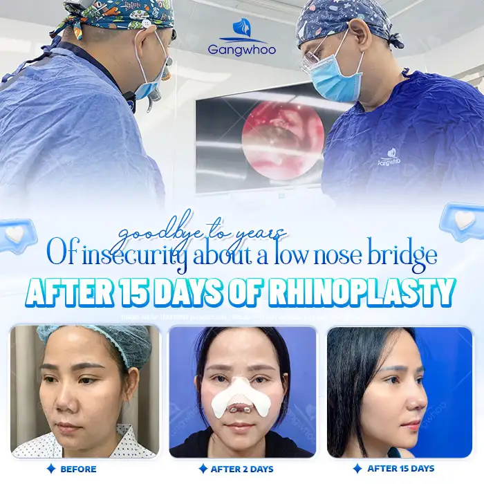 How long does it take for an S Line rhinoplasty to look beautiful? Factors affecting recovery time
