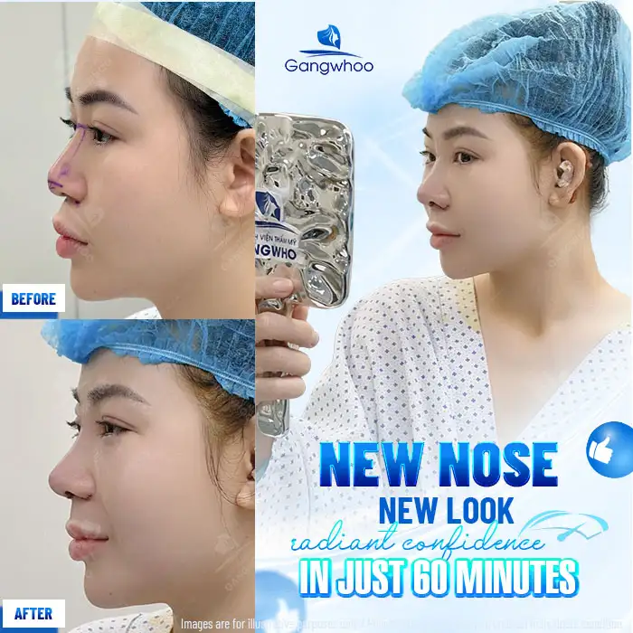 How long does it take for an S Line rhinoplasty to look beautiful? Factors affecting recovery time