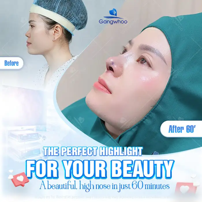 How long does it take for an S Line rhinoplasty to look beautiful? Factors affecting recovery time