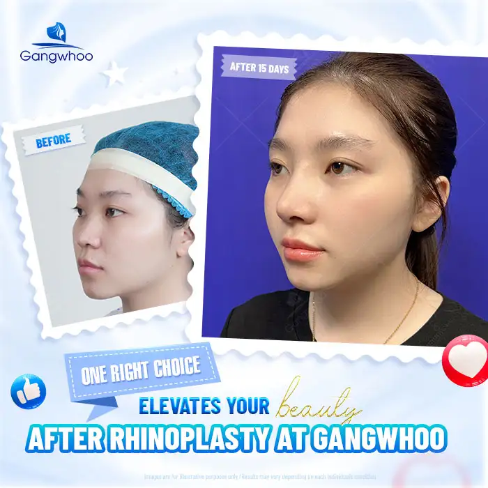 Is S Line Rhinoplasty Permanent? How Long Can the Results Last?