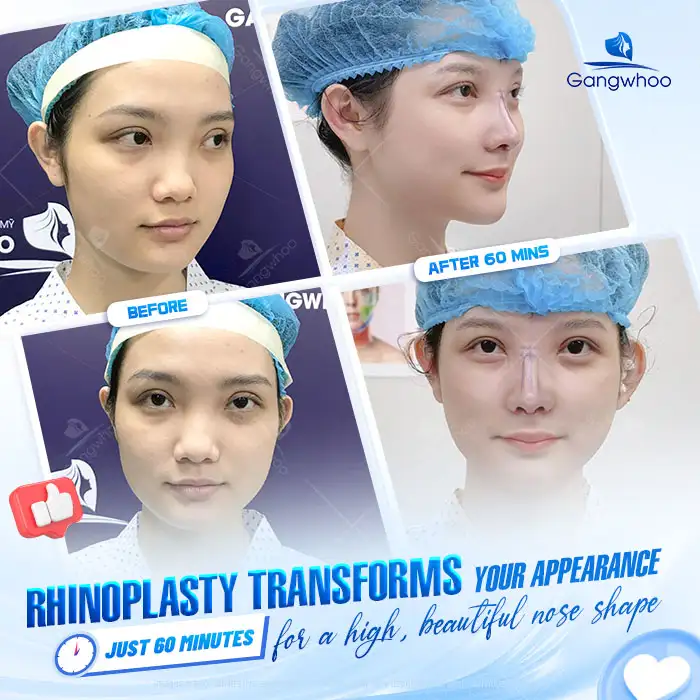 Is S Line Rhinoplasty Permanent? How Long Can the Results Last?