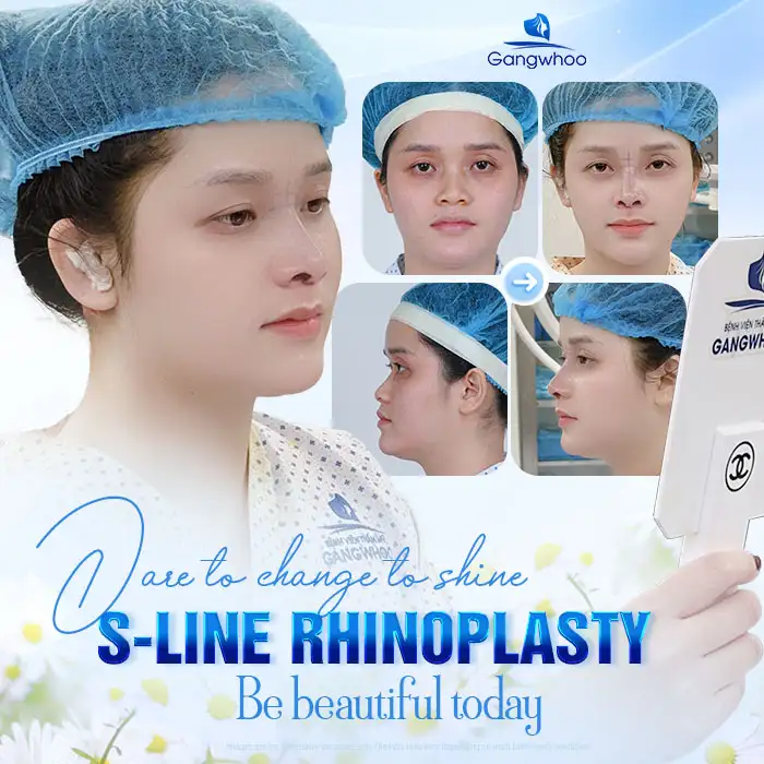 Is S Line Rhinoplasty Permanent? How Long Can the Results Last?