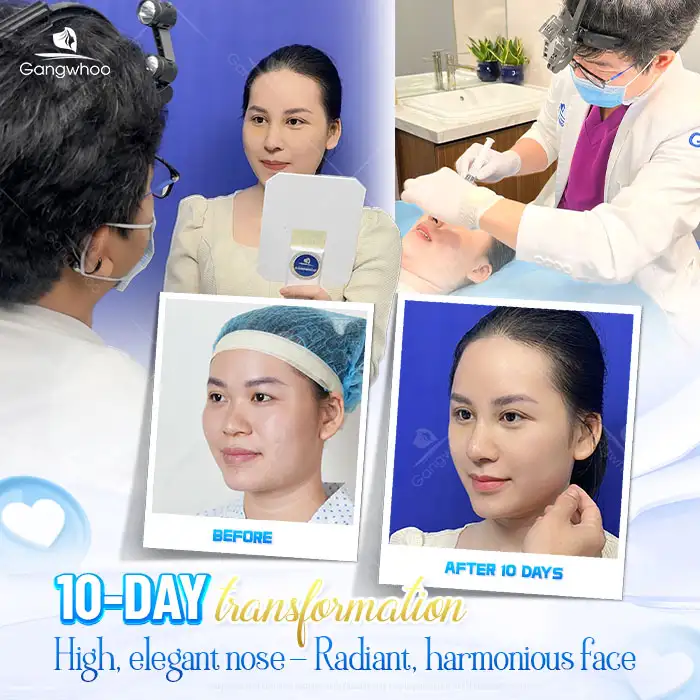 Is S Line Rhinoplasty Permanent? How Long Can the Results Last?