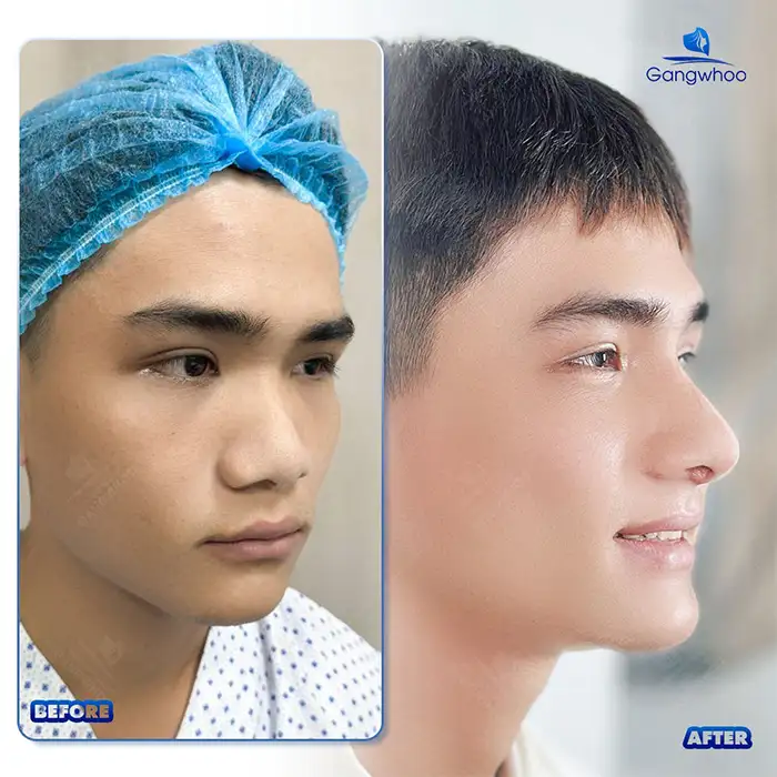 Should you choose S Line or L Line rhinoplasty to suit your face?