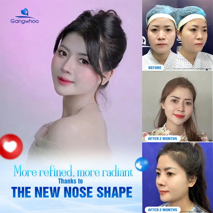 Where Is the Best Place for S Line Rhinoplasty? 7 Reputable Clinics in Ho Chi Minh City