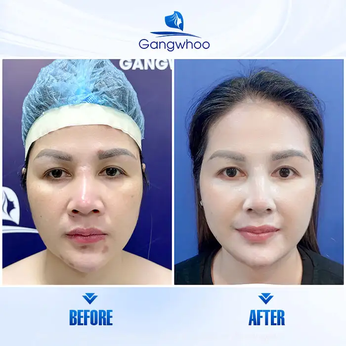 Is Nasal Swelling After 1 Year of Rhinoplasty Dangerous? How Should It Be Treated? 4 Is Nasal Swelling After 1 Year of Rhinoplasty Dangerous? How Should It Be Treated?