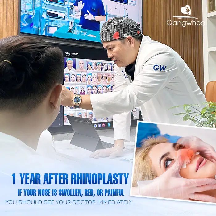 Is Nasal Swelling After 1 Year of Rhinoplasty Dangerous? How Should It Be Treated? 3 Is Nasal Swelling After 1 Year of Rhinoplasty Dangerous? How Should It Be Treated?