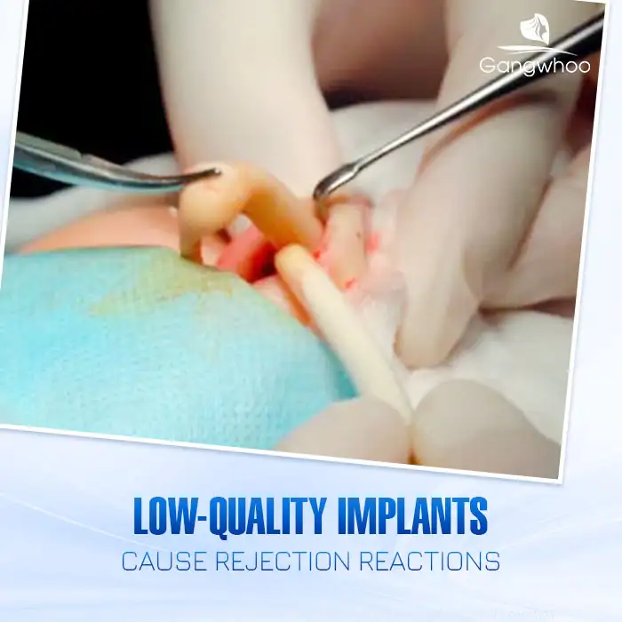Is Nasal Swelling After 1 Year of Rhinoplasty Dangerous? How Should It Be Treated? 1 Is Nasal Swelling After 1 Year of Rhinoplasty Dangerous? How Should It Be Treated?
